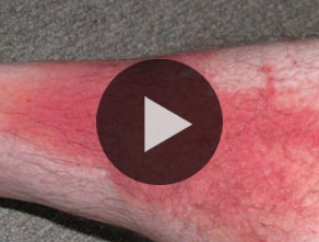 alzheimers and itching